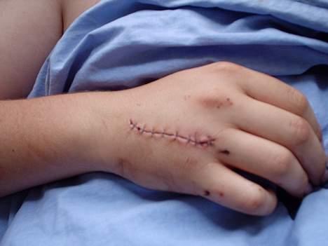 Peugeot SPEEDFIGHT LC 30 (SOLGT) - efter politiet påkørte mig billede 20