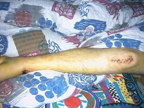 PGO Hot 50 SOLGT - Da jeg kørte galt på min hot den dag i dag  2006 har jeg stadig en 30 cm hjern stang i mit ben  billede 19