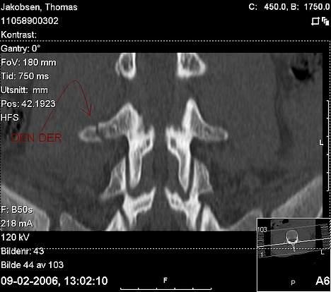 Honda Amigo "pro Extrem# M-Side - ja det er så min lænd/nederst ved rykken som jeg har flækket noget af efter at have stået på ski! :(  billede 14