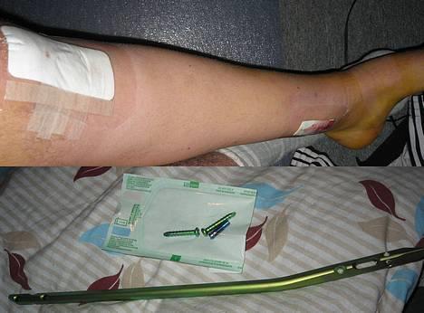 Derbi Senda SM Solgt :(  - Ja det er mit ben efter operationen.. 16.01.2007 det er den stang der har været i mit ben i 2 år  billede 19